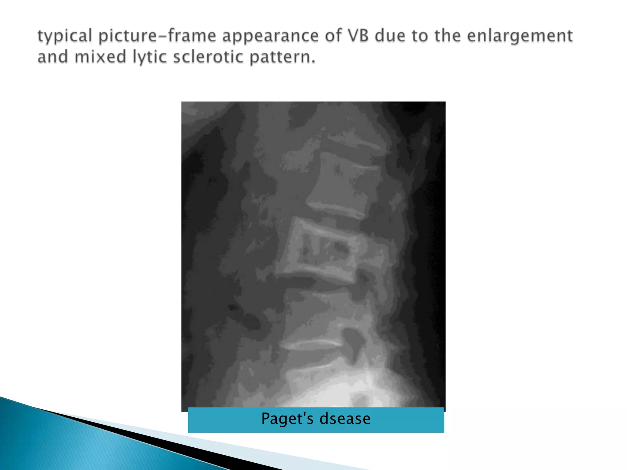 typical picture-frame appearance of VB due to the enlargement and mixed lytic sclerotic pattern. Paget's dsease