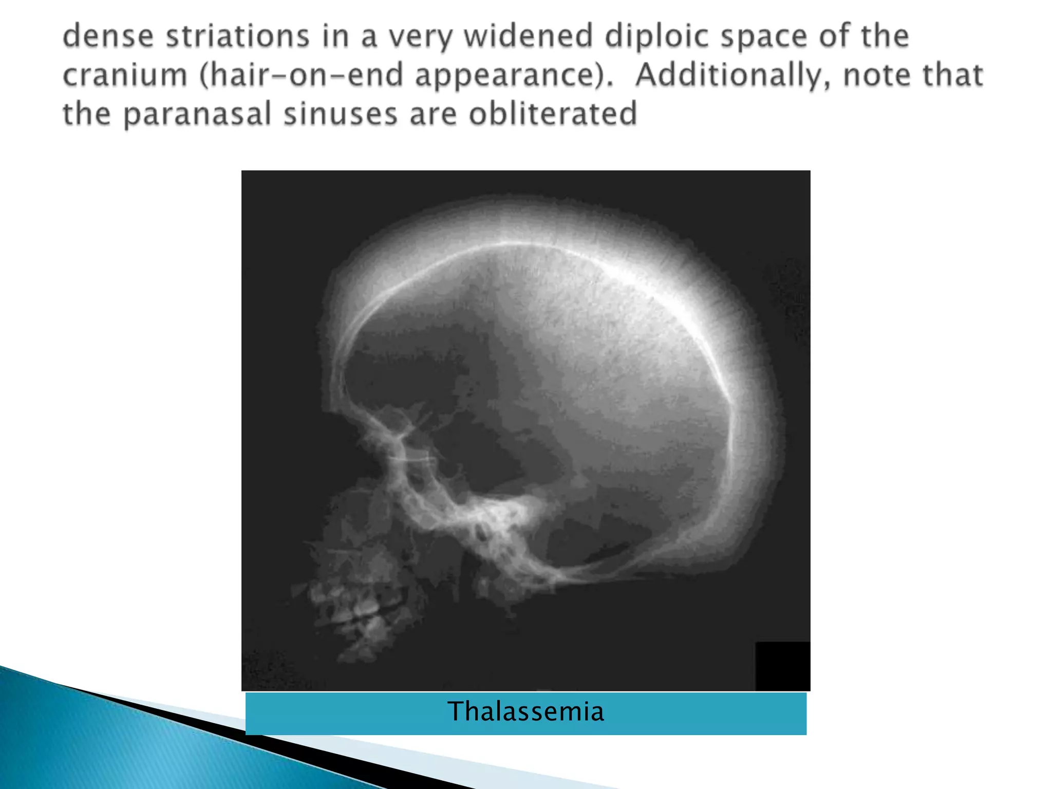dense striations in a very widened diploic space of the cranium (hair-on-end appearance).  Additionally, note that the paranasal sinuses are obliteratedThalassemia