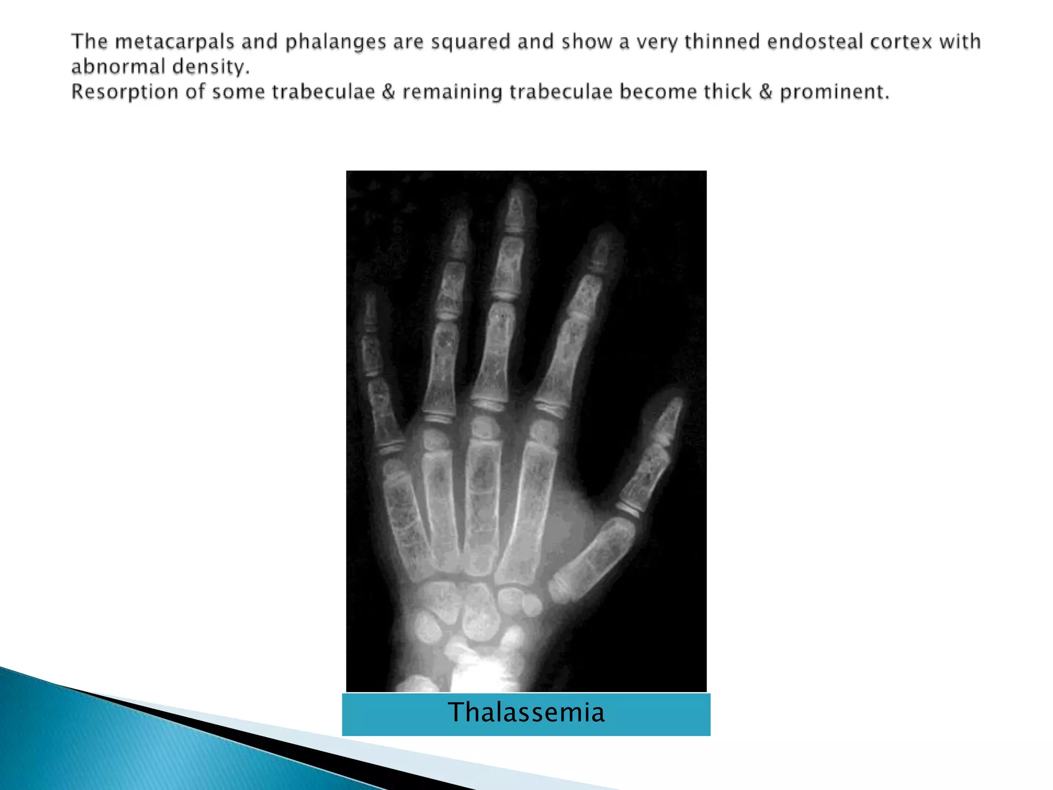 The metacarpals and phalanges are squared and show a very thinned endosteal cortex with abnormal density. Resorption of some trabeculae & remaining trabeculae become thick & prominent.Thalassemia