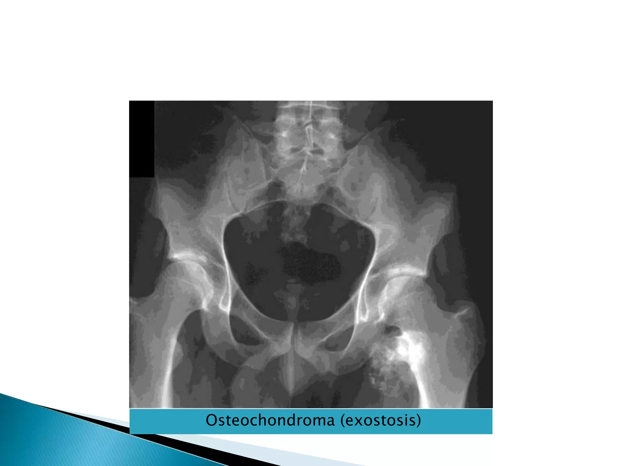 Osteochondroma (exostosis)