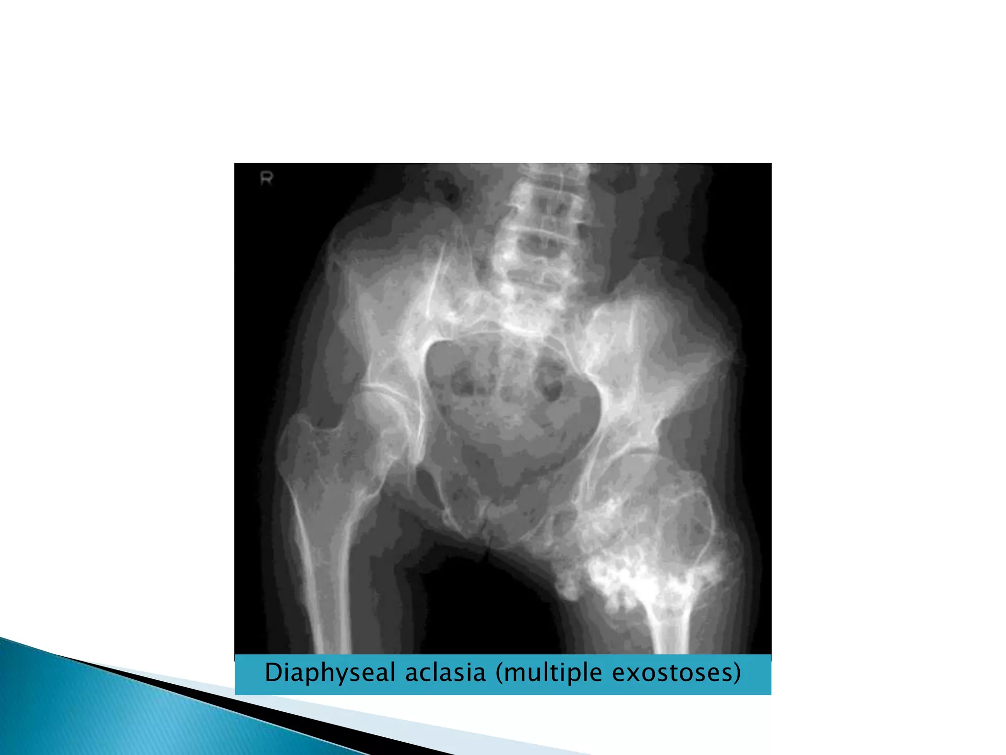 Diaphyseal aclasia (multiple exostoses)