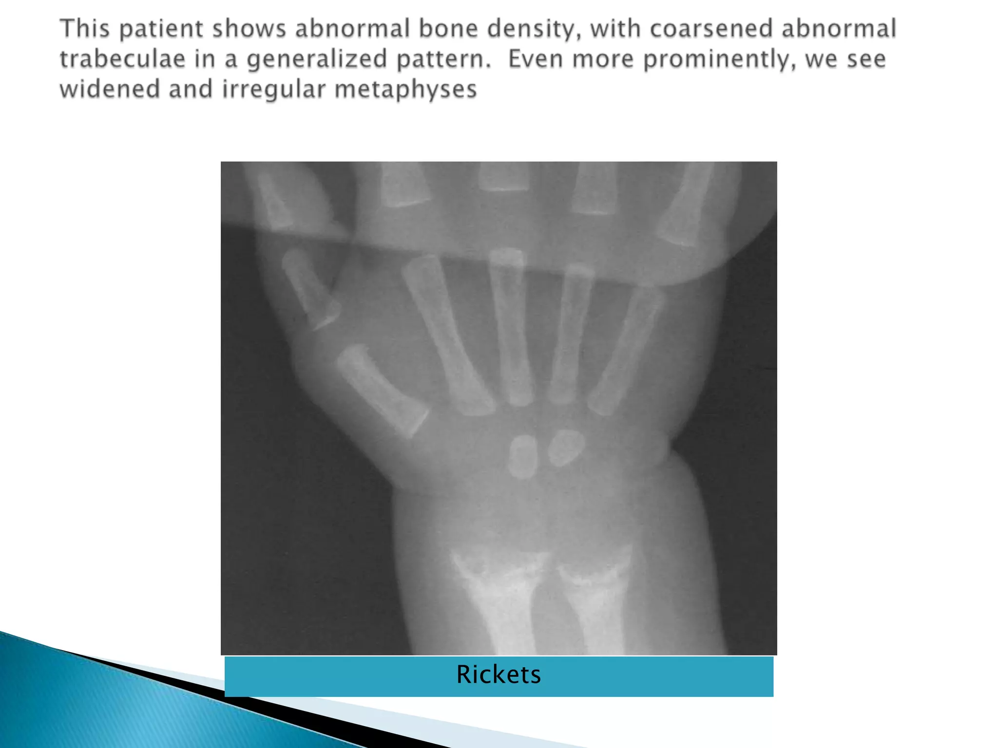 This patient shows abnormal bone density, with coarsened abnormal trabeculae in a generalized pattern.  Even more prominently, we see widened and irregular metaphysesRickets