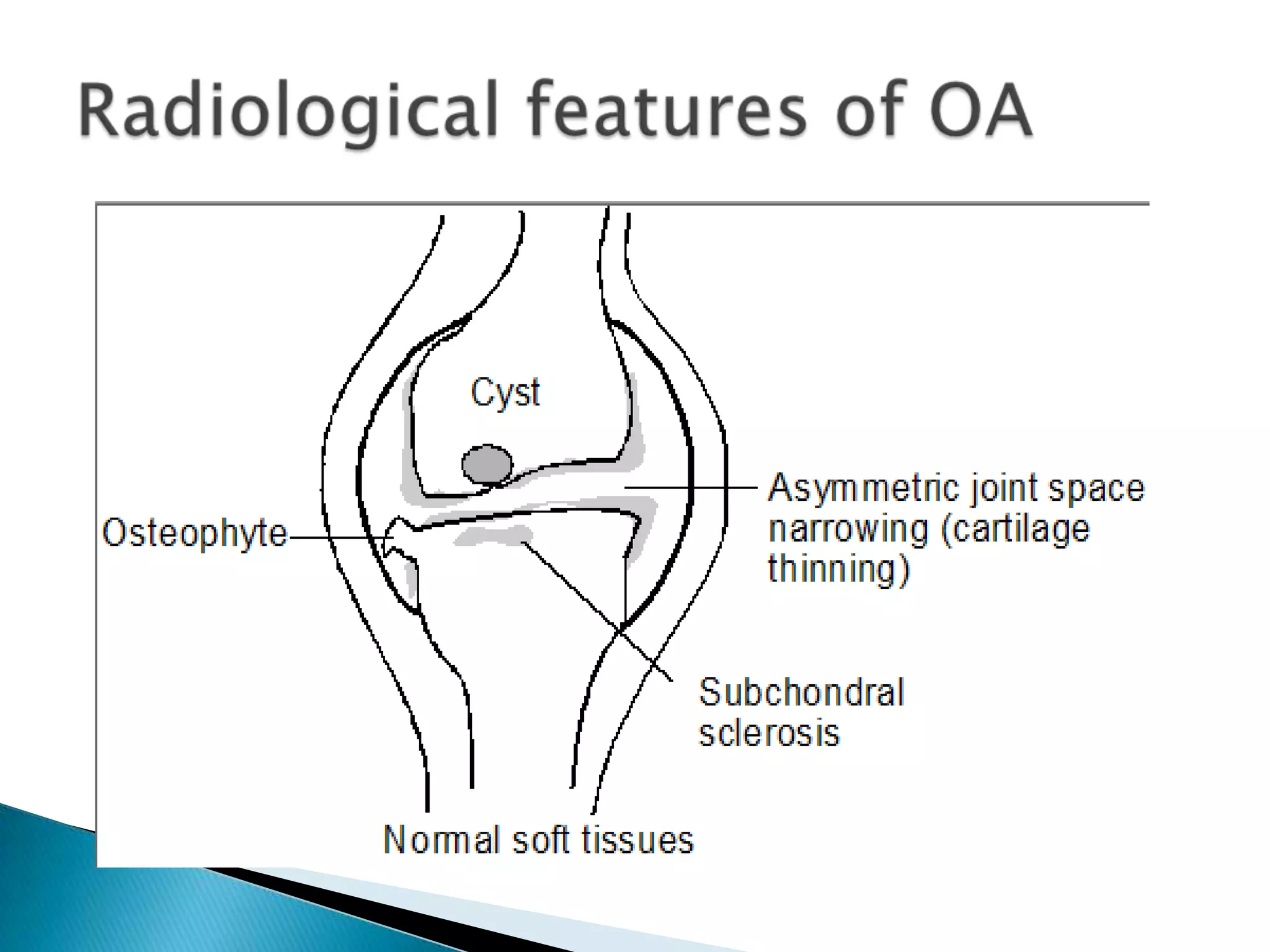 OA when seen in the hands ,it almost always involves DIP& often affect the CM joint of the thumb & in the large joints, it commonly involve hip& knee, but relatively rare in the ankle , shoulders & elbow joints unless there is some underlying causes.