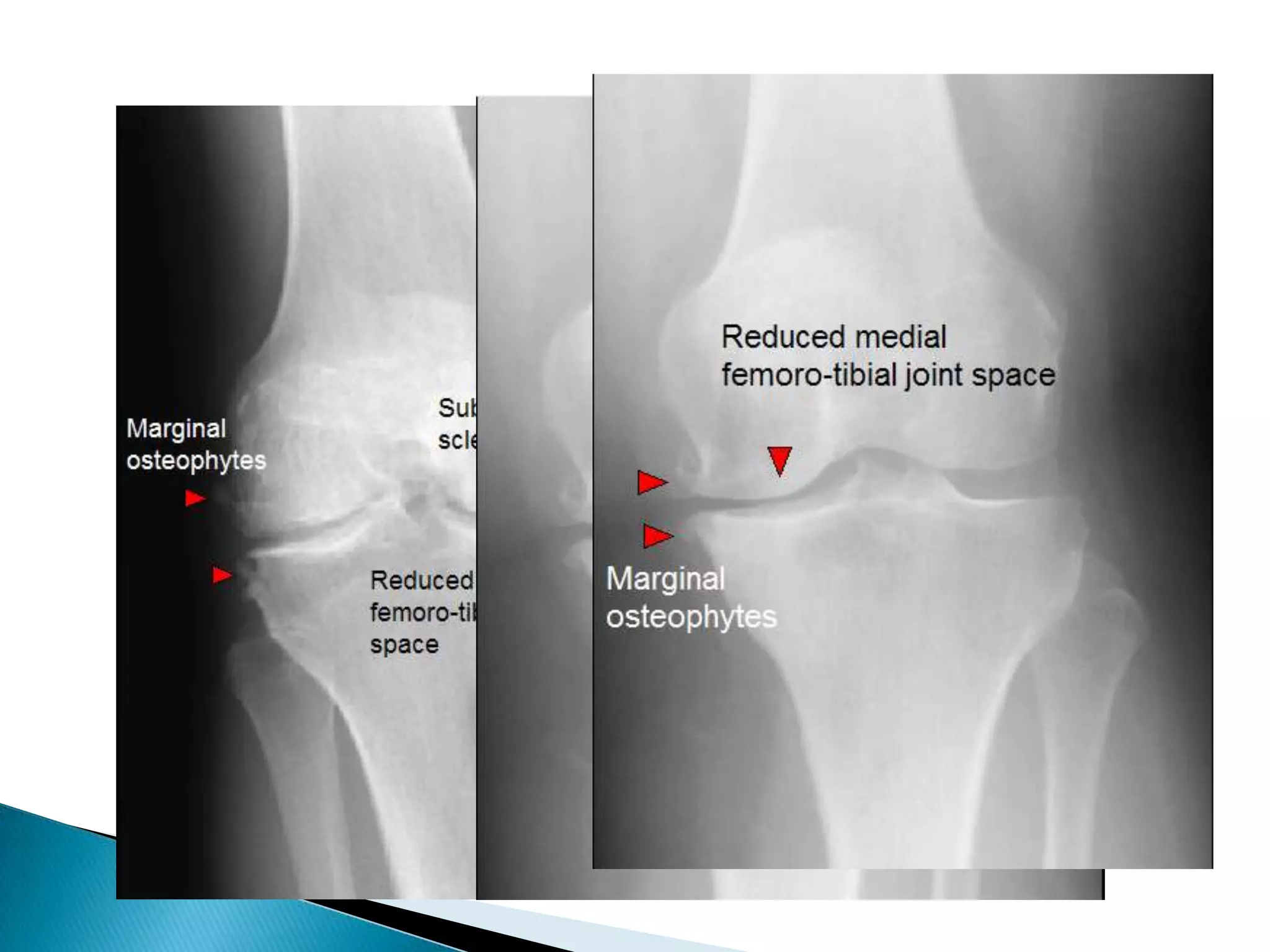 Neuropathic arthritis ; Diabetic affect ankles & feet while syringomyelia affect shoulders, elbows & hands3-Is a known disease present ?e.g hemophilia, DM