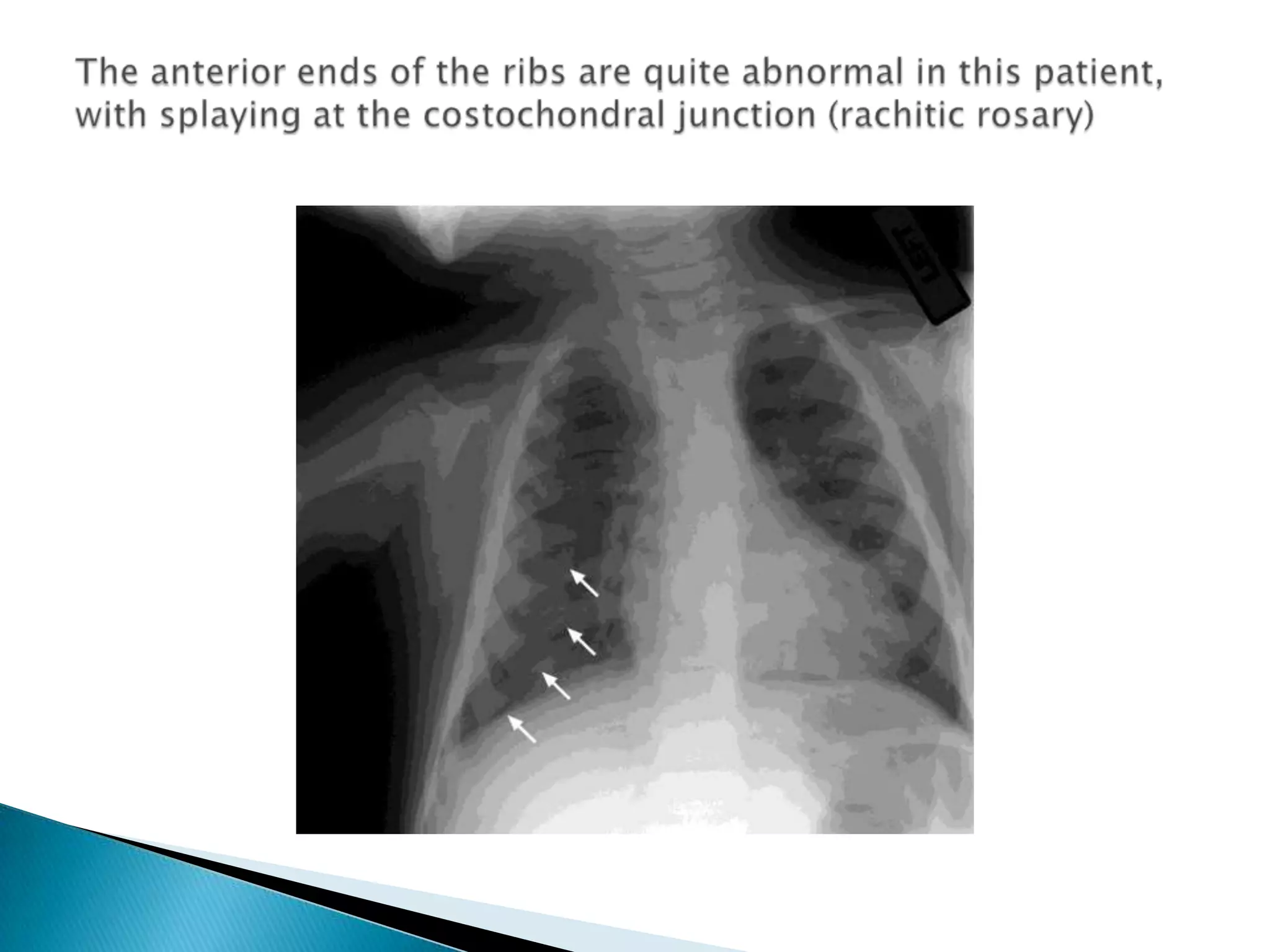 The anterior ends of the ribs are quite abnormal in this patient, with splaying at the costochondral junction (rachitic rosary) 