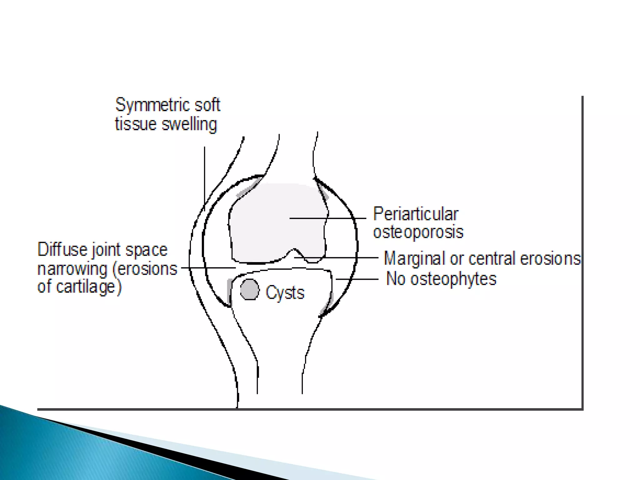 Inflammatory arthritis
