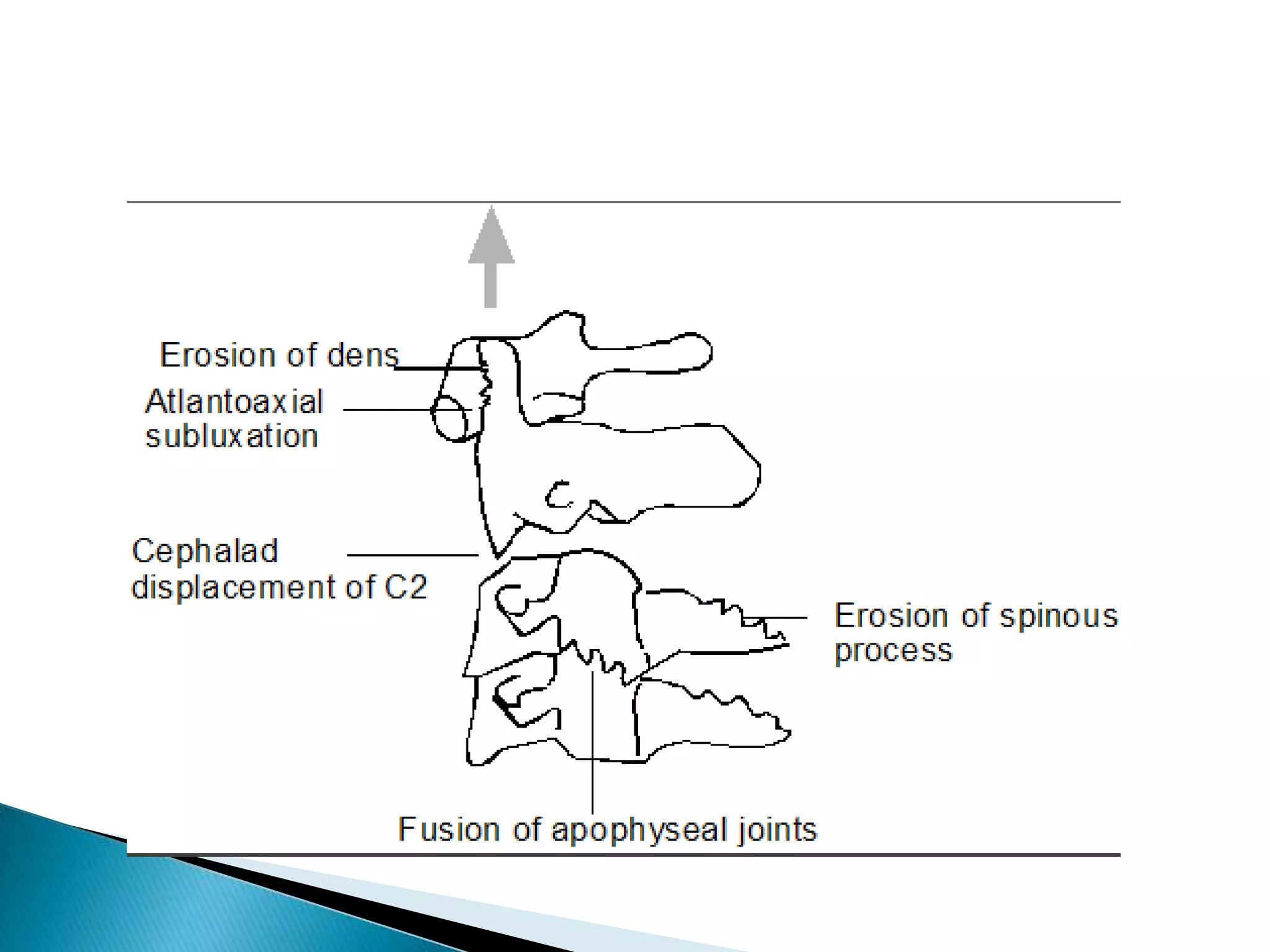 Rheumatoid Arthritis
