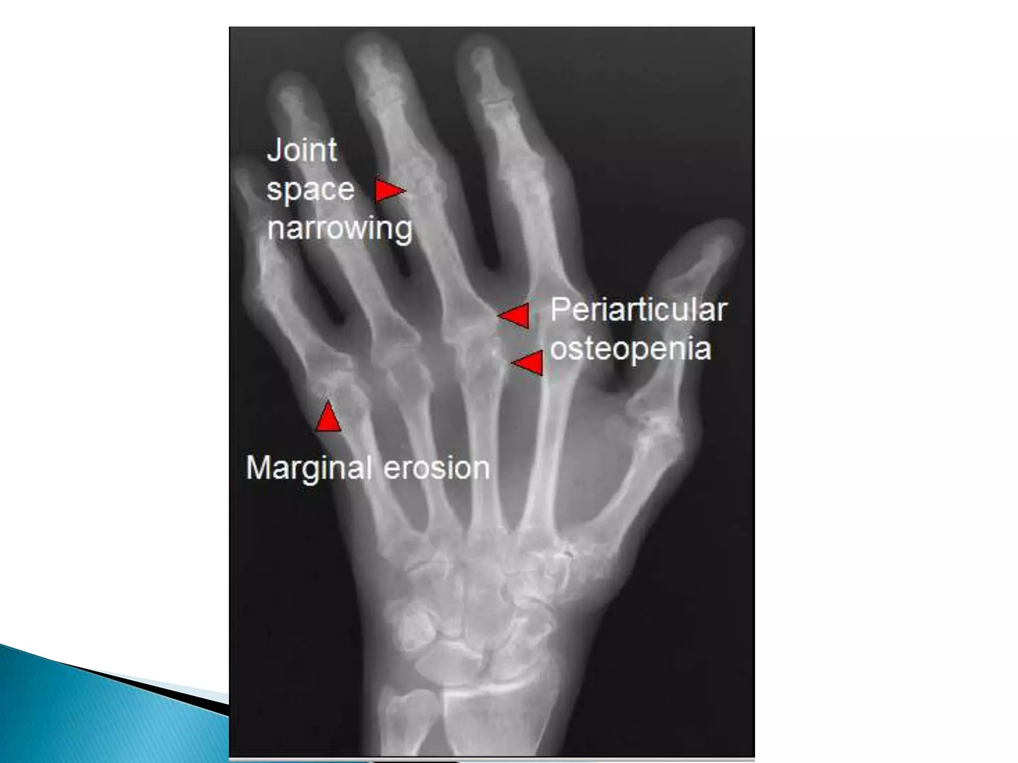 Radiological features of RA