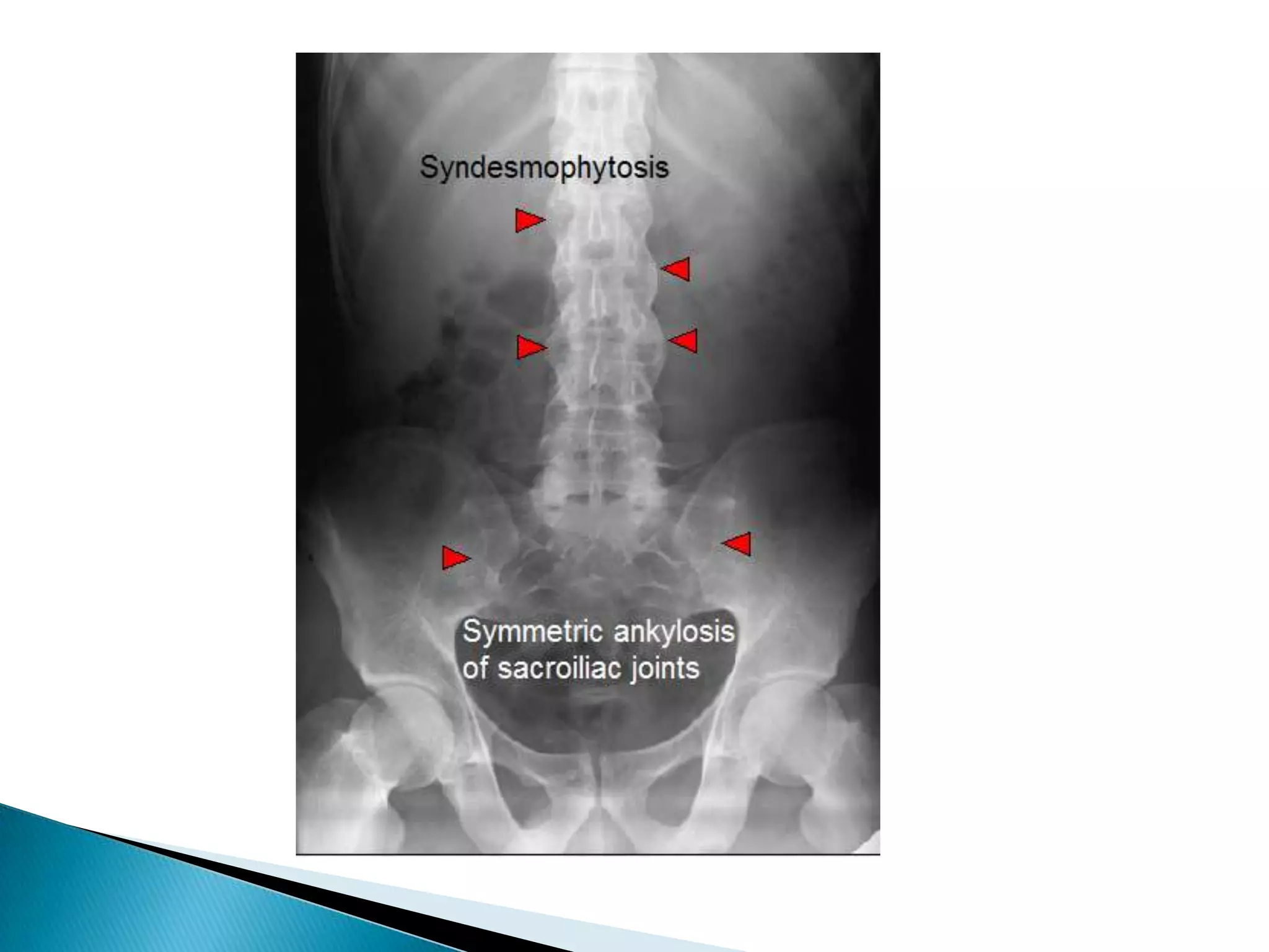 OAJoint space narrowed max. at wt bearing site
