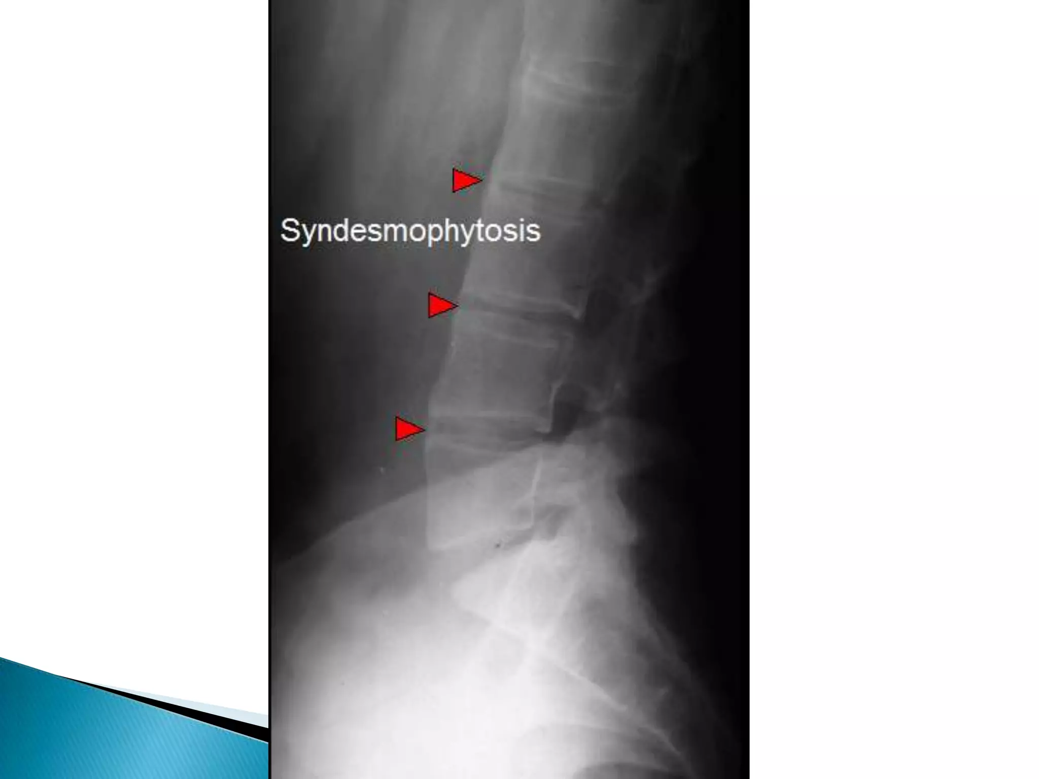 Erosion do no occur.