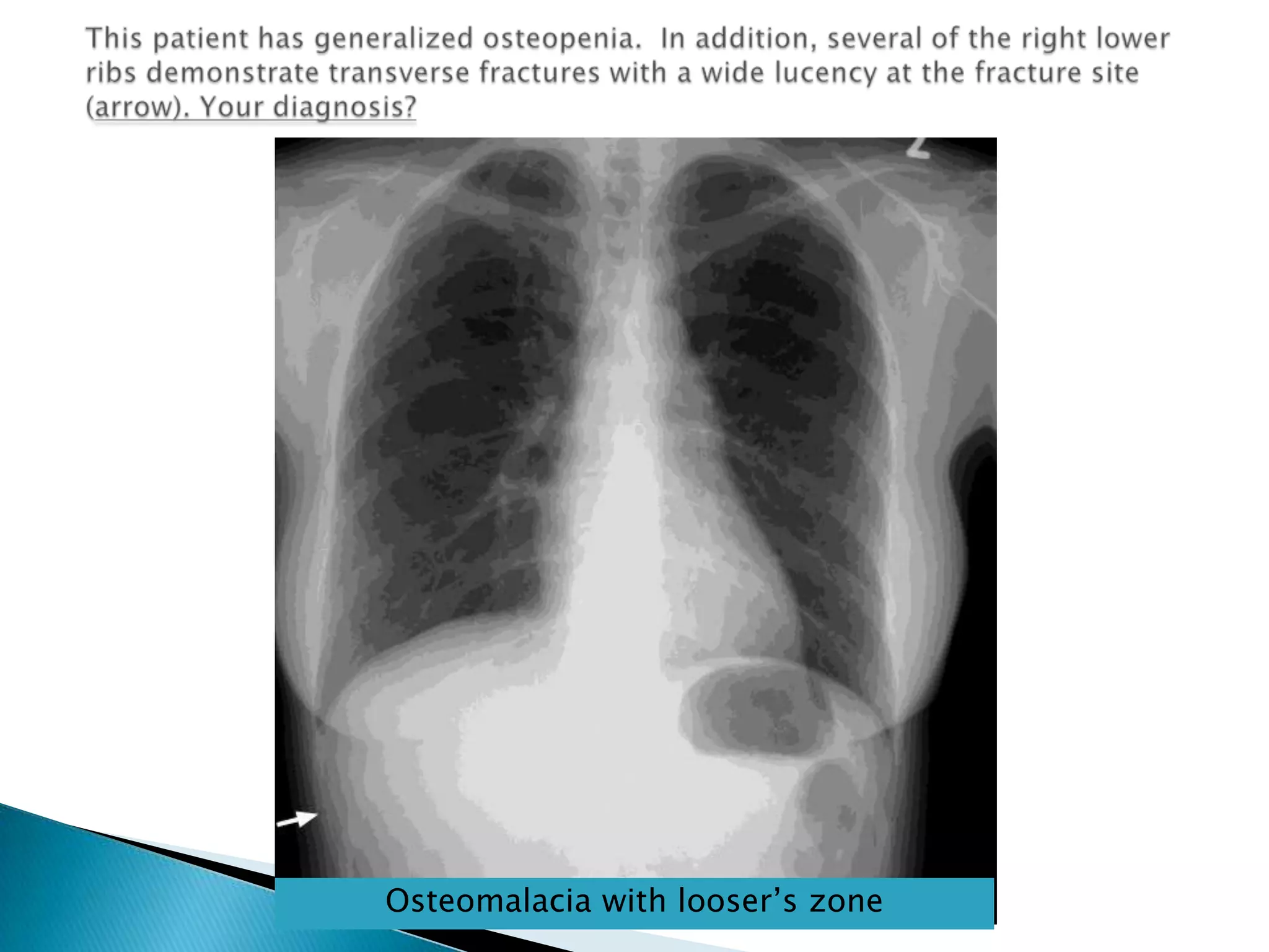 This patient has generalized osteopenia.  In addition, several of the right lower ribs demonstrate transverse fractures with a wide lucency at the fracture site (arrow). Your diagnosis?Osteomalacia with looser’s zone