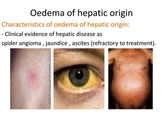 There can be an elevated jugular venous pressure.Oedema of renal originNephrotic syndrome is defined as a glomerular disease that results in proteinuria(urinary protein loss of ≥ 3.5 gm/day), hypoproteinemia, oedema, and hyperlipidemia.