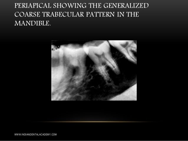 Generalized rarefaction of jaw bones /prosthodontic courses