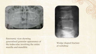Wedge shaped fracture
of vertebrae
Panoramic view showing
generalized granular appearance of
the trabeculae involving the entire
maxilla and mandible.
 