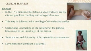 CLINICAL FEATURES
RICKETS
• In the 1st 6 months of life,tetany and convulsions are the
clinical problems resulting due to hypocalcaemia
• This may be followed with swelling of the wrist and ankles
• Craniotabes .a softening of the posterior of the parietal
bones may be the initial sign of the disease
• Short stature and deformity of the extremities are common
• Development of dentition is delayed ,
 
