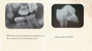 Thinning or decreased mineralization of
the enamel seen in bitewing view.
Large pulp chamber
 