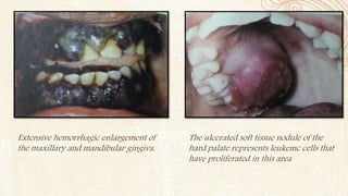 Extensive hemorrhagic enlargement of
the maxillary and mandibular gingiva.
The ulcerated soft tissue nodule of the
hard palate represents leukemc cells that
have proliferated in this area
 