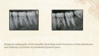 Periapical radiographs of left mandible illustrating multi focal areas of bone destruction
and widening of portions of periodontal ligament space.
 