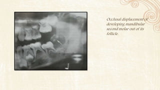 Occlusal displacement of
developing mandibular
second molar out of its
follicle.
 