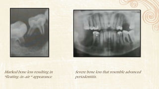 Marked bone loss resulting in
“floating-in-air “ appearance
Severe bone loss that resemble advanced
periodontitis.
 