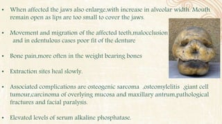 • When affected the jaws also enlarge,with increase in alveolar width. Mouth
remain open as lips are too small to cover the jaws.
• Movement and migration of the affected teeth,malocclusion
and in edentulous cases poor fit of the denture
• Bone pain,more often in the weight bearing bones
• Extraction sites heal slowly.
• Associated complications are osteogenic sarcoma ,osteomylelitis ,giant cell
tumour,carcinoma of overlying mucosa and maxillary antrum,pathological
fractures and facial paralysis.
• Elevated levels of serum alkaline phosphatase.
 