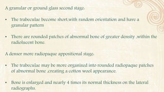 A granular or ground glass second stage:
• The trabeculae become short,with random orientation and have a
granular pattern
• There are rounded patches of abnormal bone of greater density ,within the
radiolucent bone.
A denser more radiopaque appositional stage:
• The trabeculae may be more organized into rounded radiopaque patches
of abnormal bone ,creating a cotton wool appearance.
• Bone is enlarged and nearly 4 times its normal thickness on the lateral
radiographs.
 