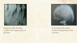 Periapical film showing
“cotton wool” appearance of
the bone
Lateral skull film shows
marked enlargement of the
cranium.
 