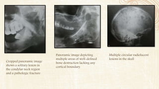 Multiple circular radiolucent
lesions in the skull
Panoramic image depicting
multiple areas of well-defined
bone destruction lacking any
cortical boundary.
Cropped panoramic image
shows a solitary lesion in
the condylar neck region
and a pathologic fracture
 