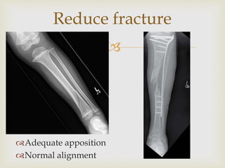 General management of fractures | PPTX