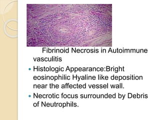 Fibrinoid Necrosis in Autoimmune
vasculitis
 Histologic Appearance:Bright
eosinophilic Hyaline like deposition
near the affected vessel wall.
 Necrotic focus surrounded by Debris
of Neutrophils.
 