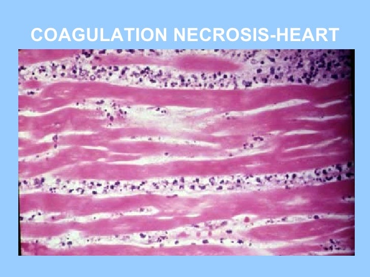 Coagulation necrosis nbme 13 pdf