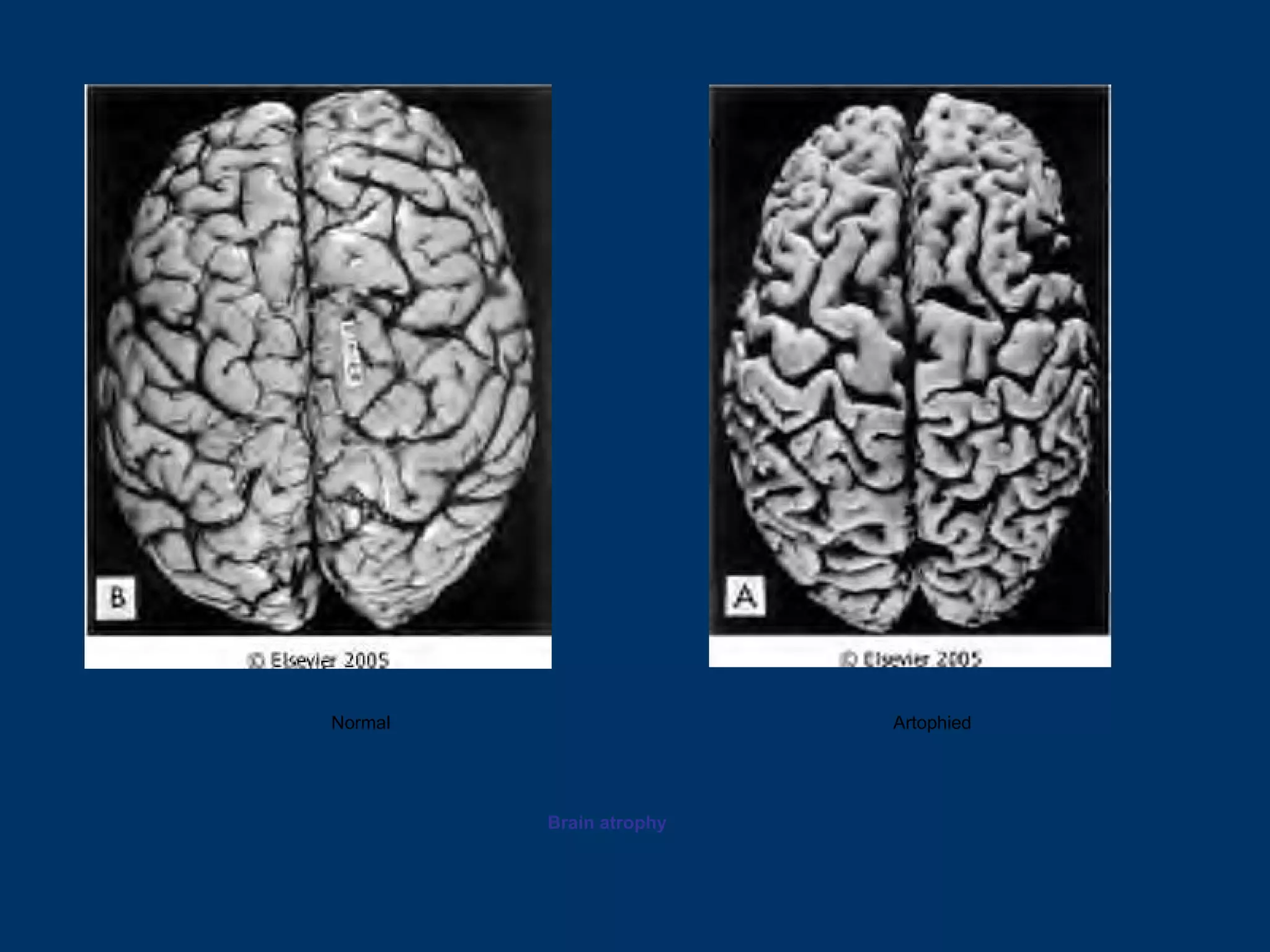 Normal                   Artophied




         Brain atrophy
 