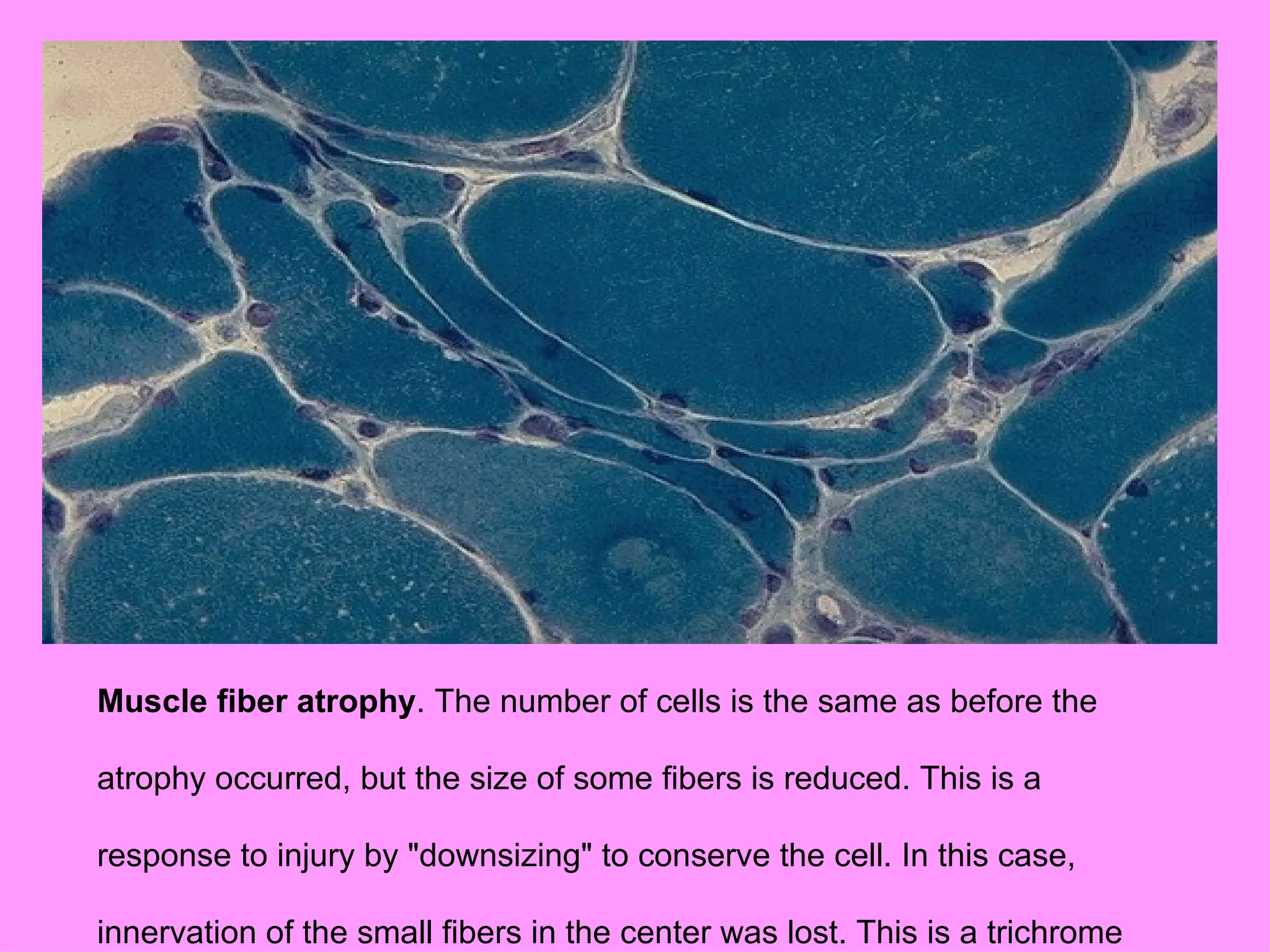 Muscle fiber atrophy. The number of cells is the same as before the

atrophy occurred, but the size of some fibers is reduced. This is a

response to injury by "downsizing" to conserve the cell. In this case,

innervation of the small fibers in the center was lost. This is a trichrome
 