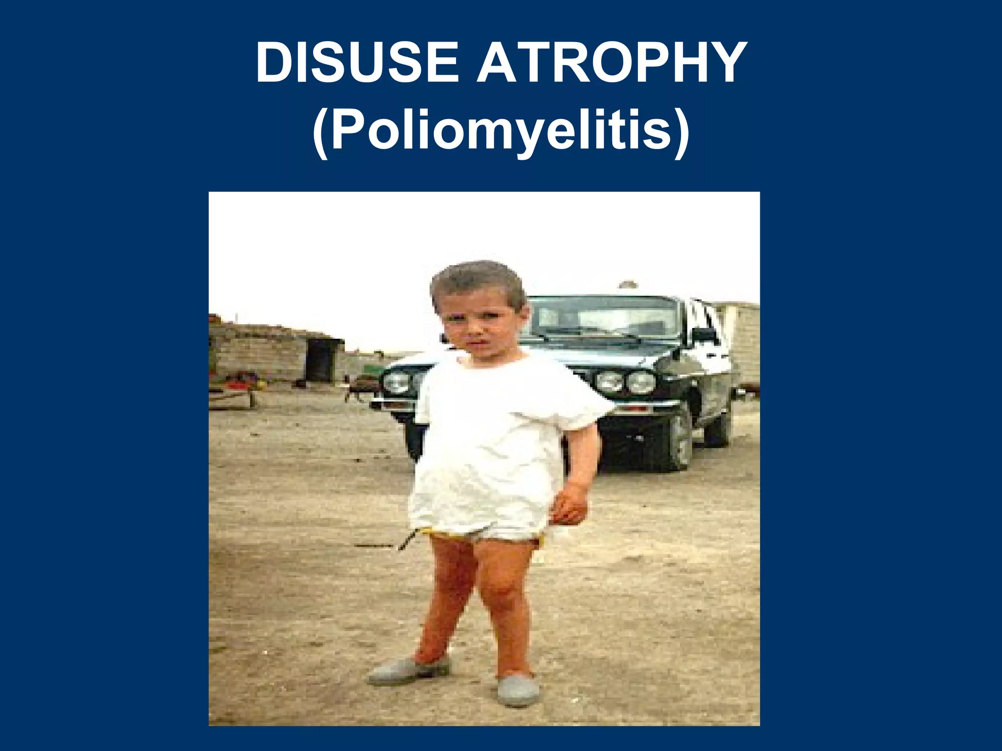 DISUSE ATROPHY
  (Poliomyelitis)
 