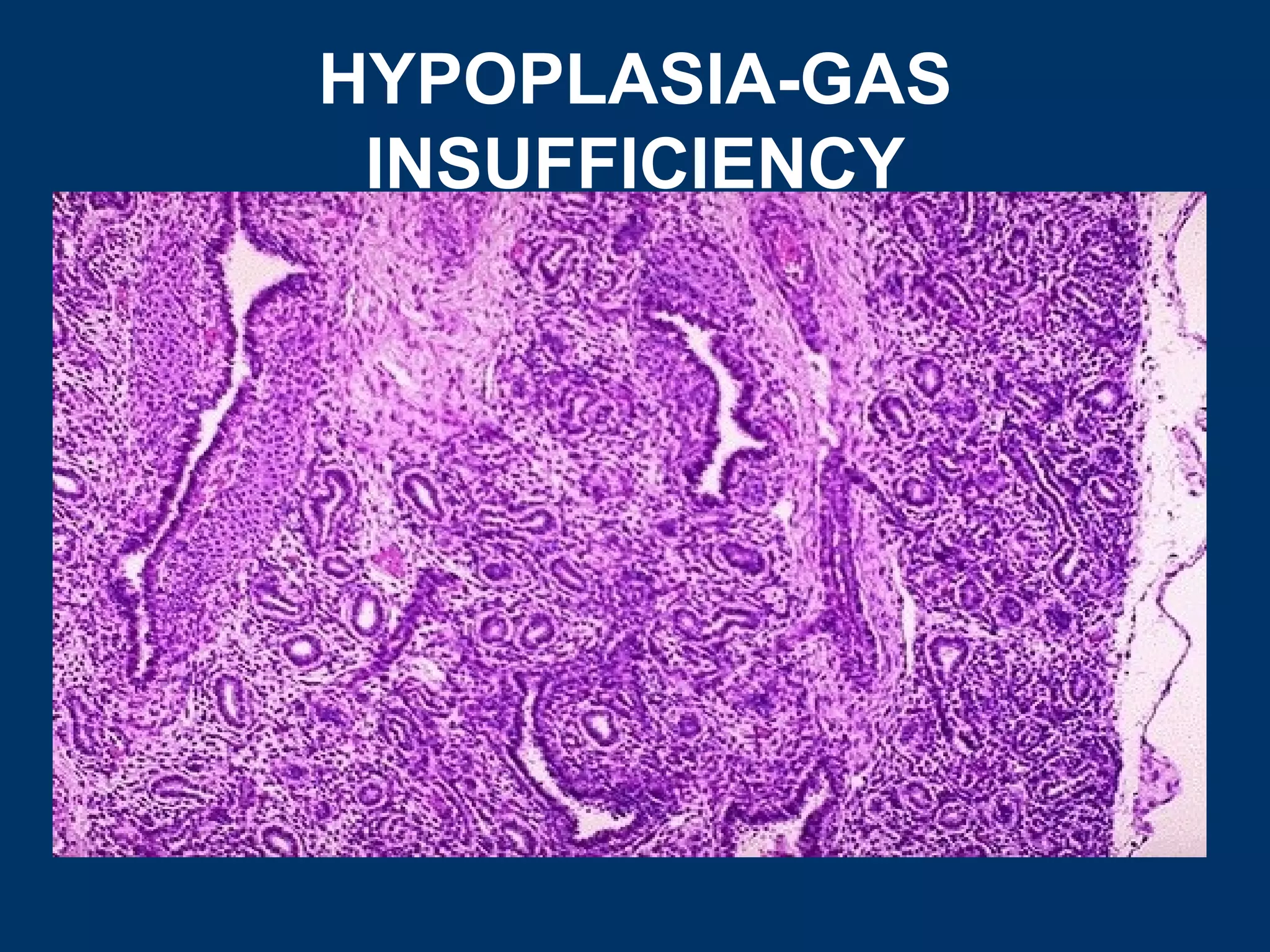 HYPOPLASIA-GAS
 INSUFFICIENCY
 