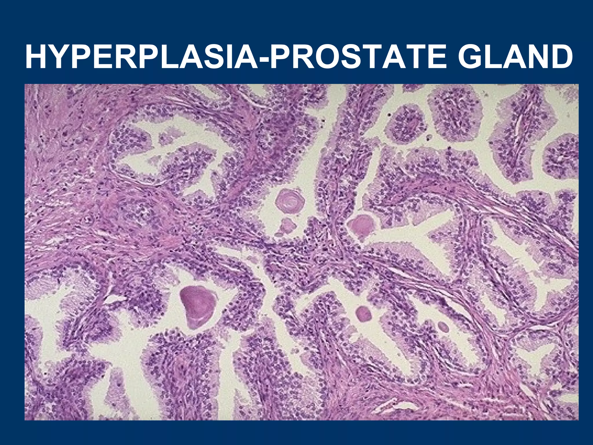 HYPERPLASIA-PROSTATE GLAND
 