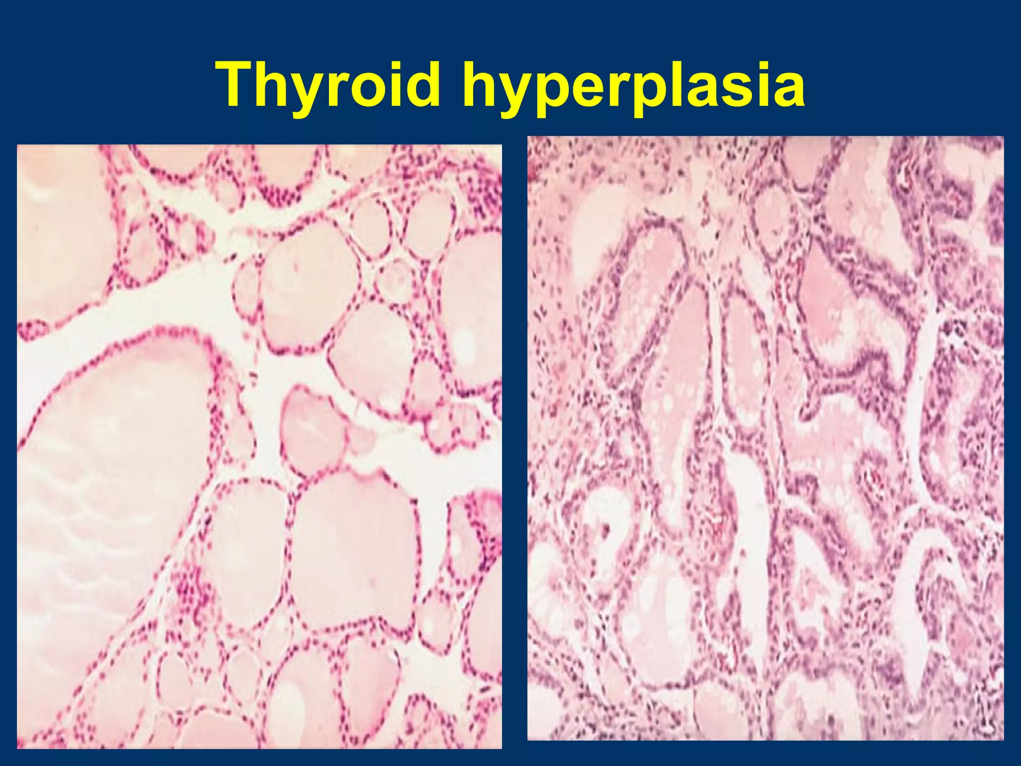 Thyroid hyperplasia
 