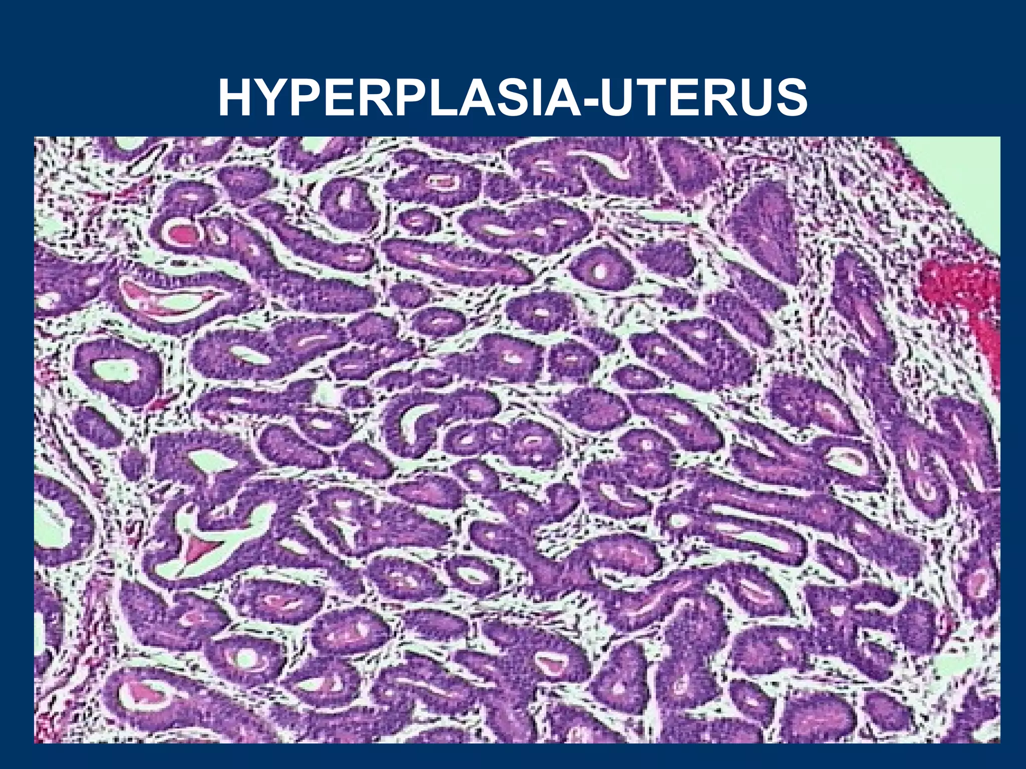 HYPERPLASIA-UTERUS
 