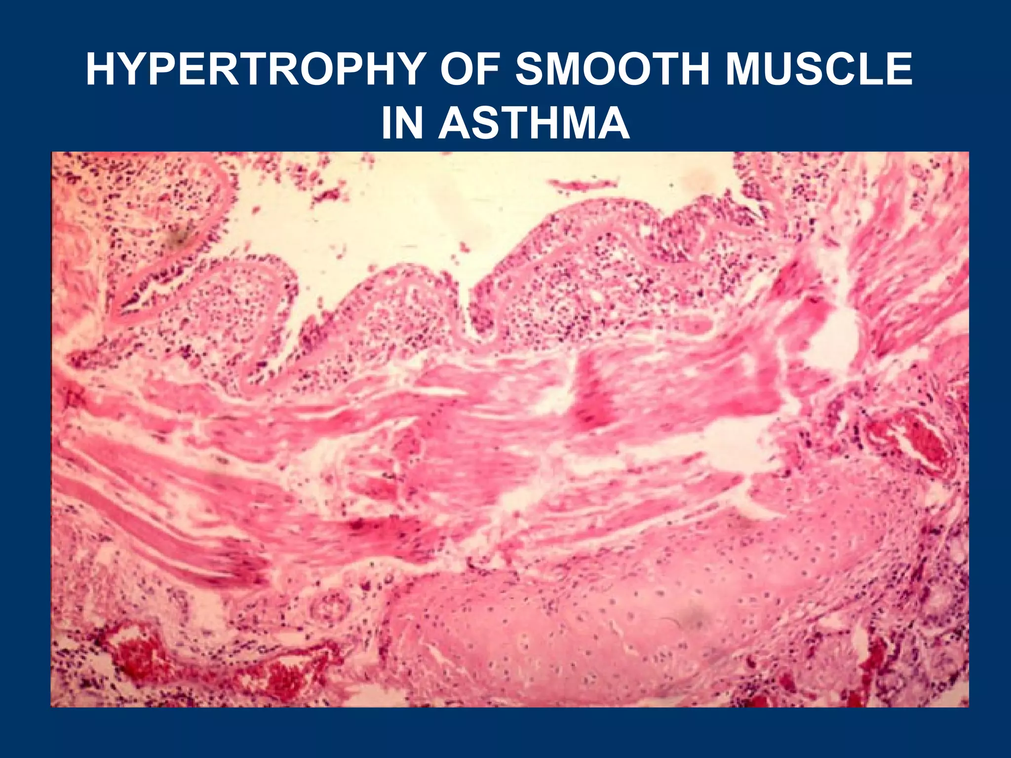 HYPERTROPHY OF SMOOTH MUSCLE
         IN ASTHMA
 