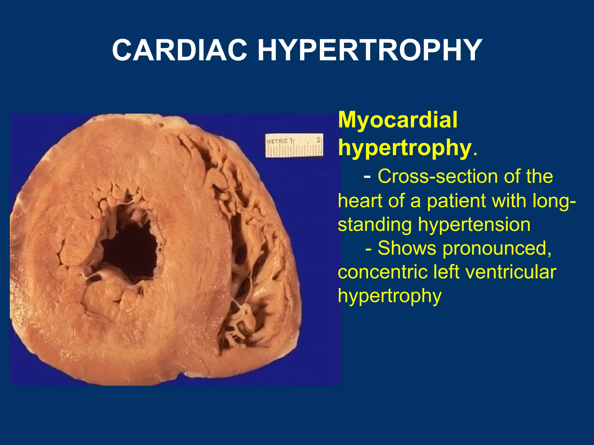 CARDIAC HYPERTROPHY

           Myocardial
           hypertrophy.
             - Cross-section of the
           heart of a patient with long-
           standing hypertension
              - Shows pronounced,
           concentric left ventricular
           hypertrophy
 
