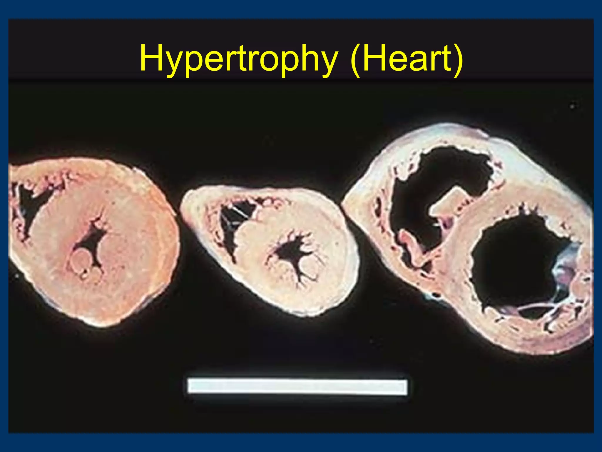 Hypertrophy (Heart)
 