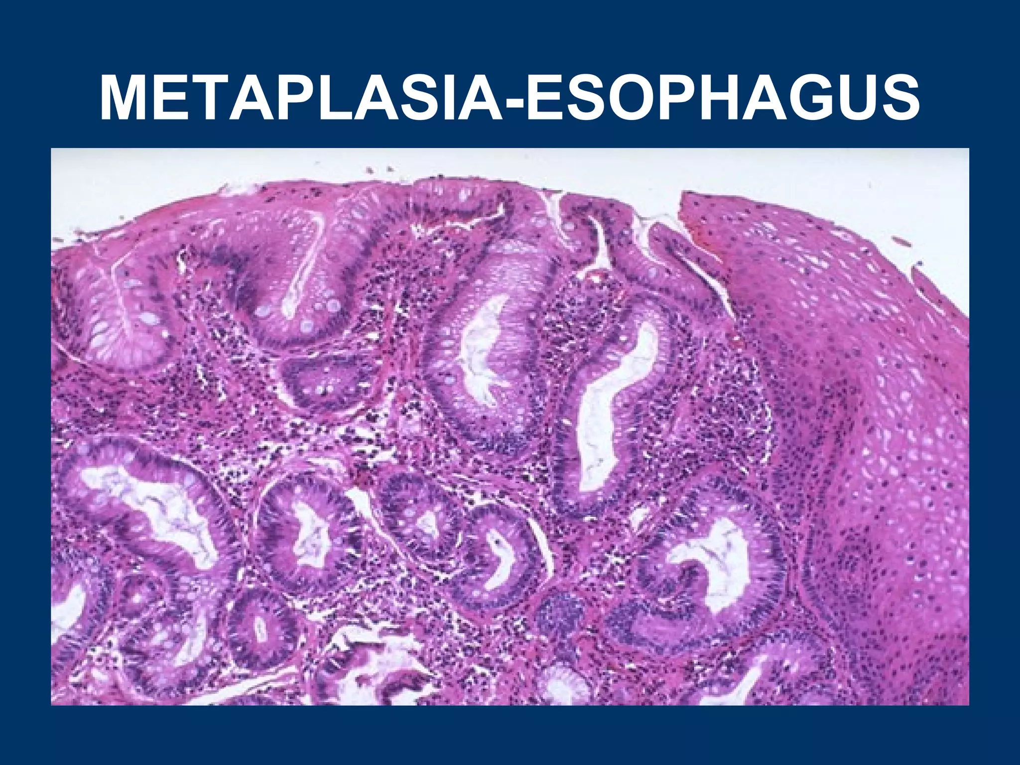 METAPLASIA-ESOPHAGUS
 