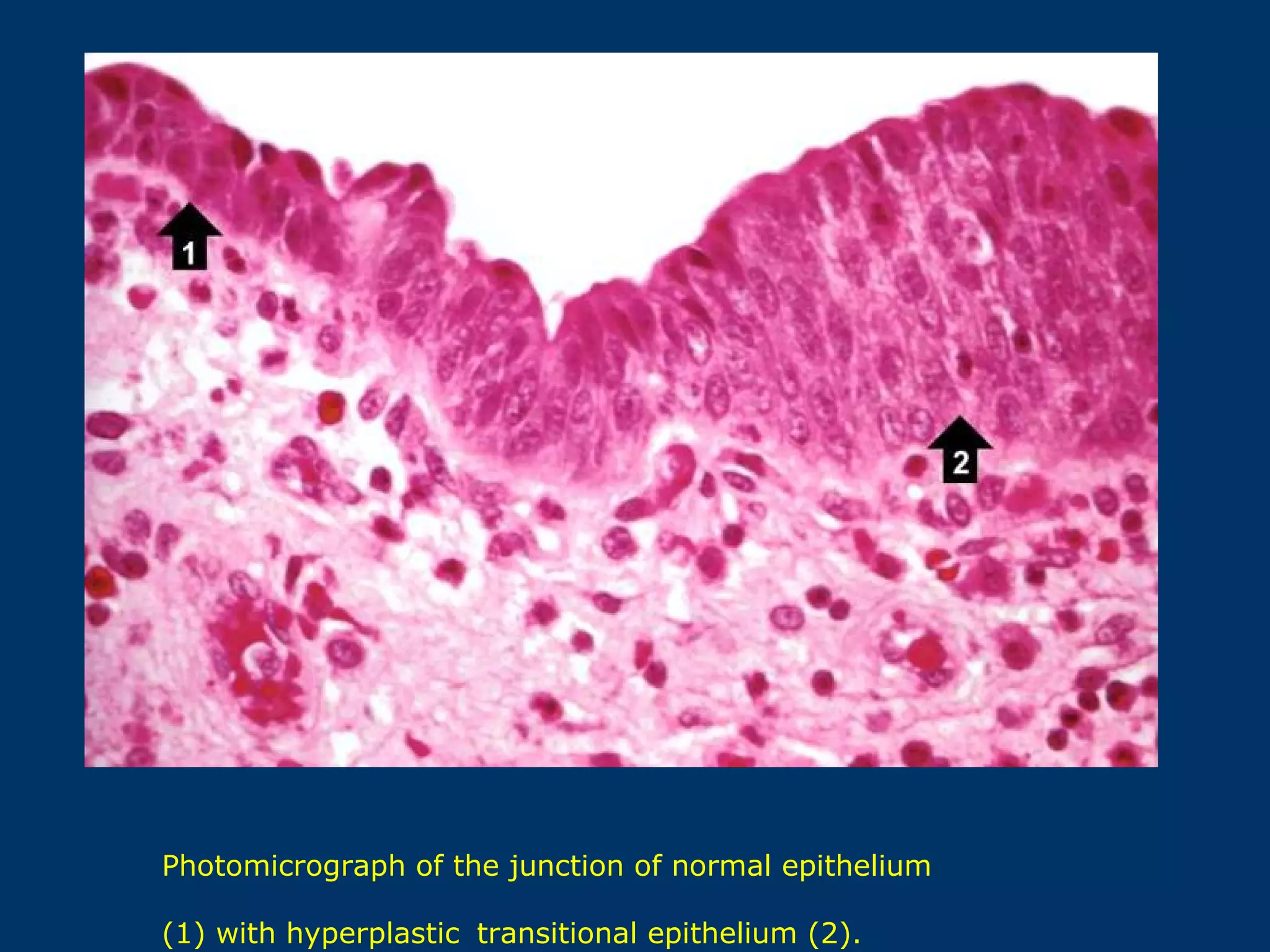 Photomicrograph of the junction of normal epithelium

(1) with hyperplastic transitional epithelium (2).
 
