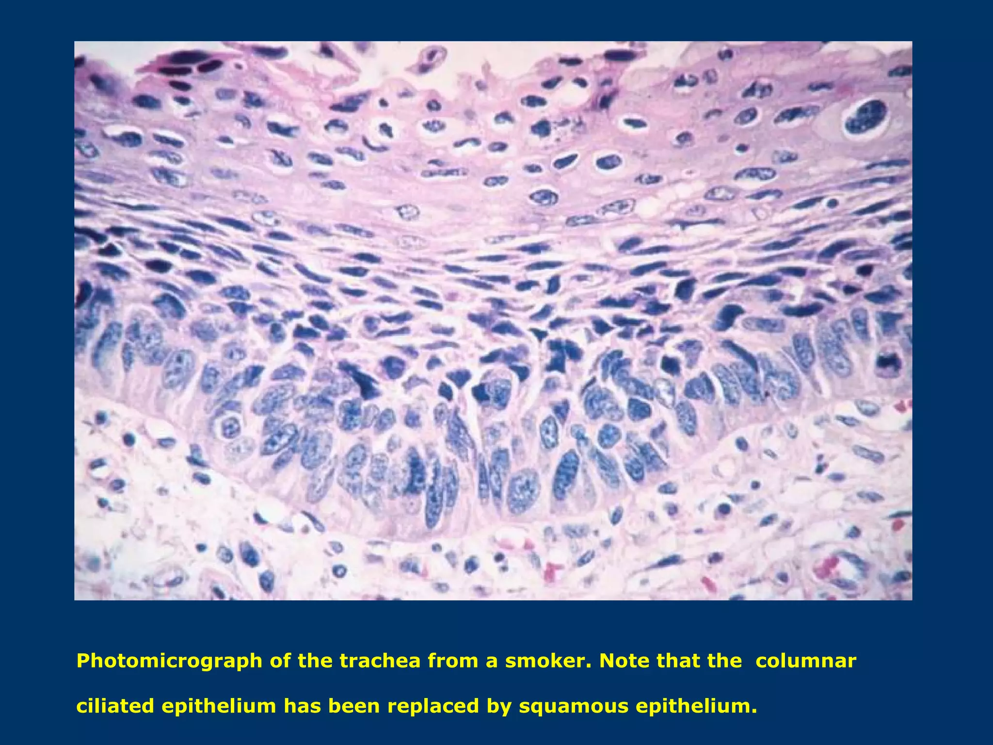 Photomicrograph of the trachea from a smoker. Note that the columnar

ciliated epithelium has been replaced by squamous epithelium.
 