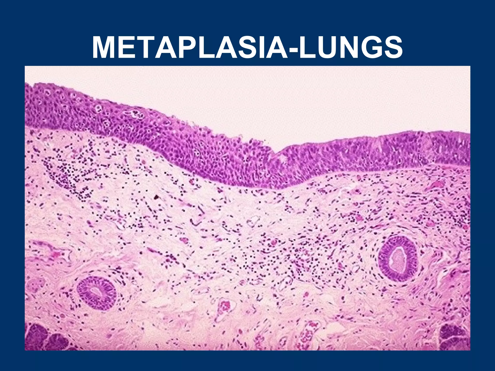 METAPLASIA-LUNGS
 