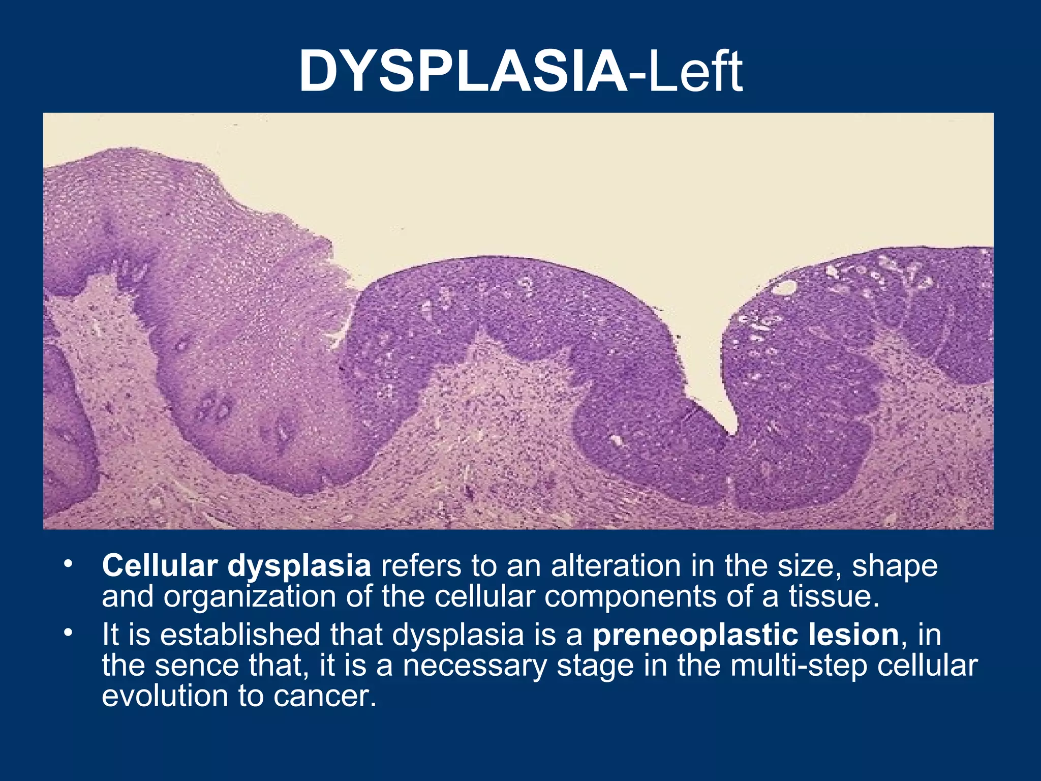 DYSPLASIA-Left




• Cellular dysplasia refers to an alteration in the size, shape
  and organization of the cellular components of a tissue.
• It is established that dysplasia is a preneoplastic lesion, in
  the sence that, it is a necessary stage in the multi-step cellular
  evolution to cancer.
 