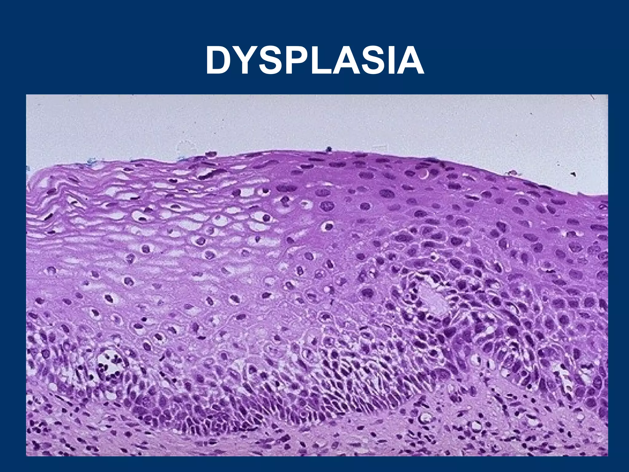 DYSPLASIA
 