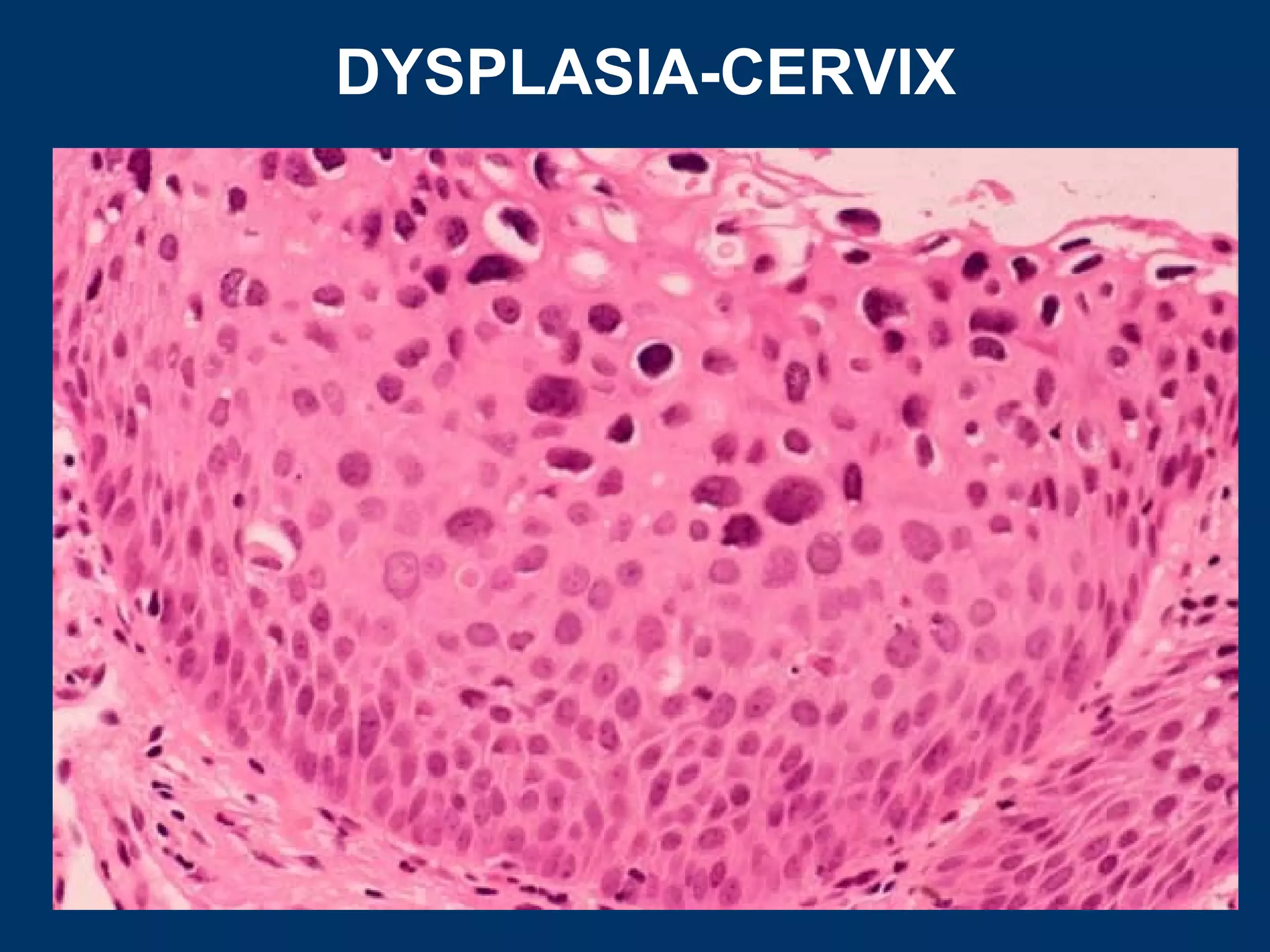 DYSPLASIA-CERVIX
 