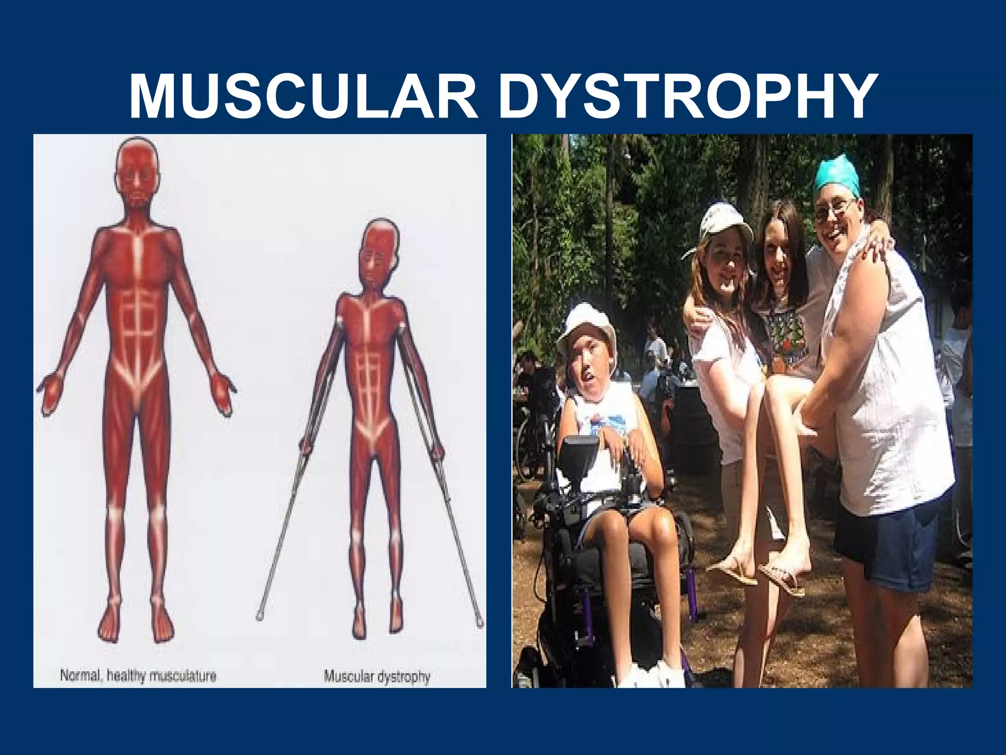 MUSCULAR DYSTROPHY
 