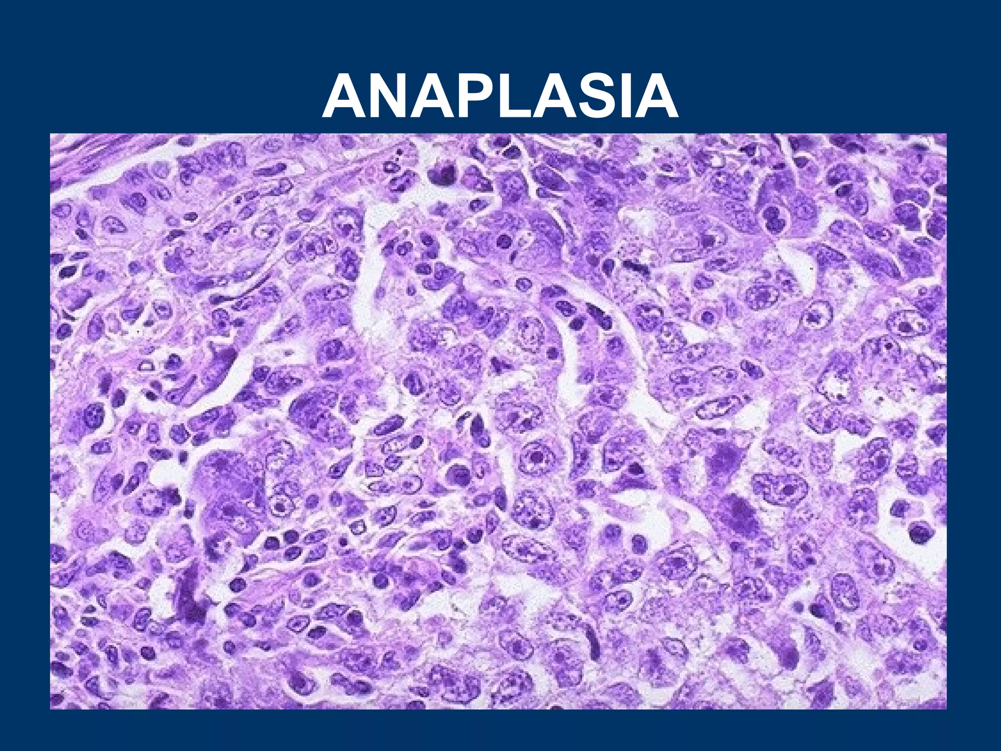 ANAPLASIA
 